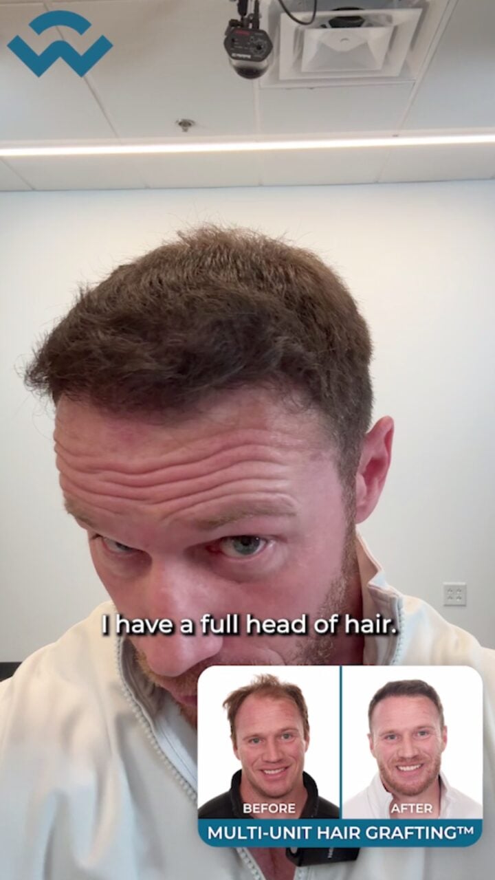 8 Months after a Hair Transplant