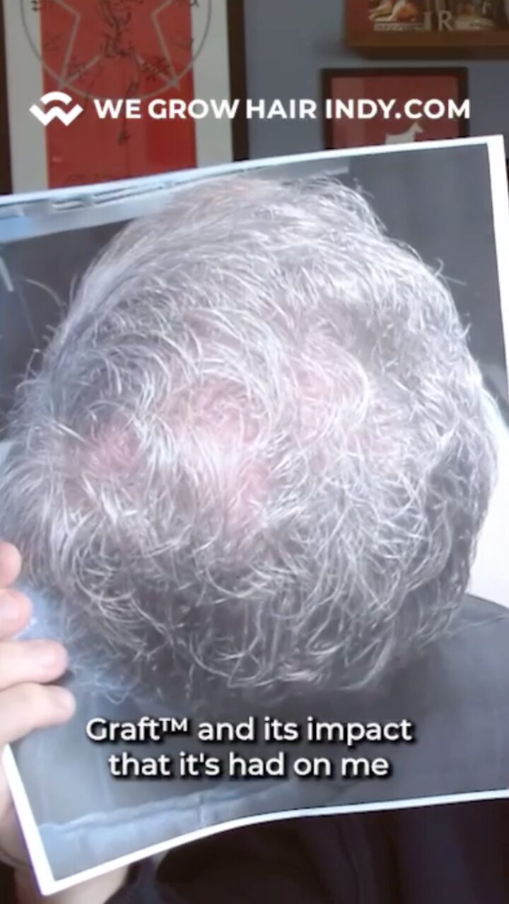 jon reens 8 months after crown transplant