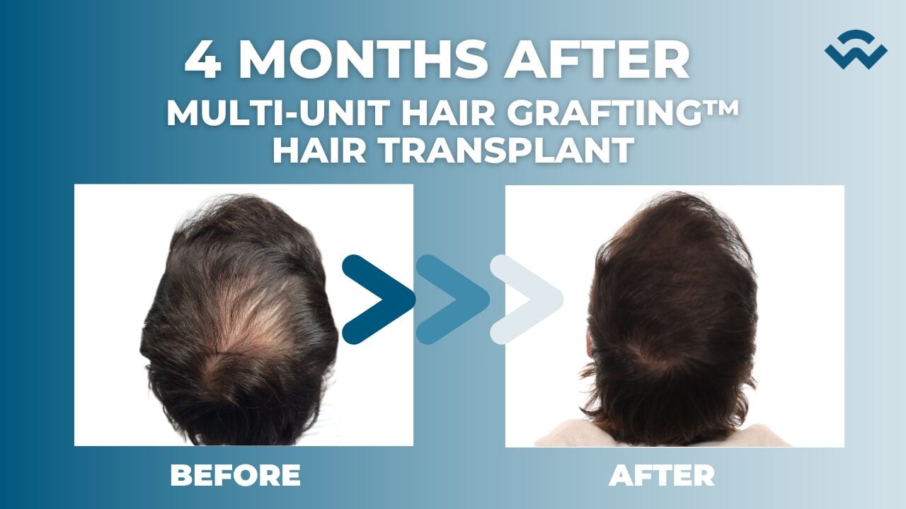 Why Get a Second Hair Transplant? | Crown & Hairline 4-Month Results