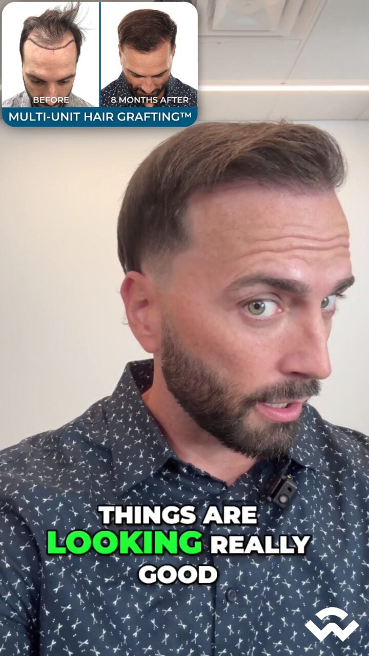 8 months after hair transplant at we grow hair indy