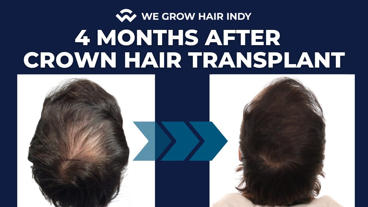 Amazing 4-Month Crown Hair Transplant Results | Natural Swirl Pattern