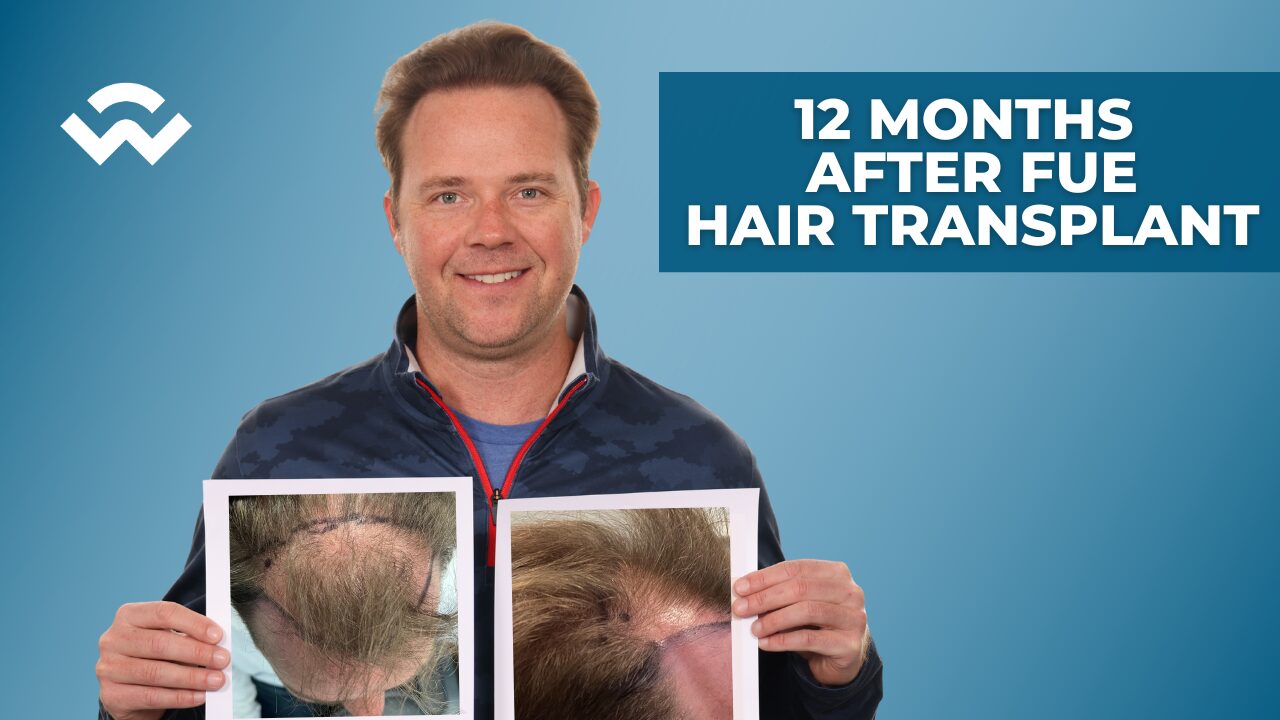 Is a FUE Hair Transplant Worth It? 12-Month Results Revealed.
