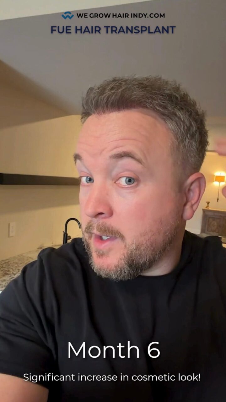 FUE HAIR TRANSPLANT TIMELINE DAY 1 - MONTH 6