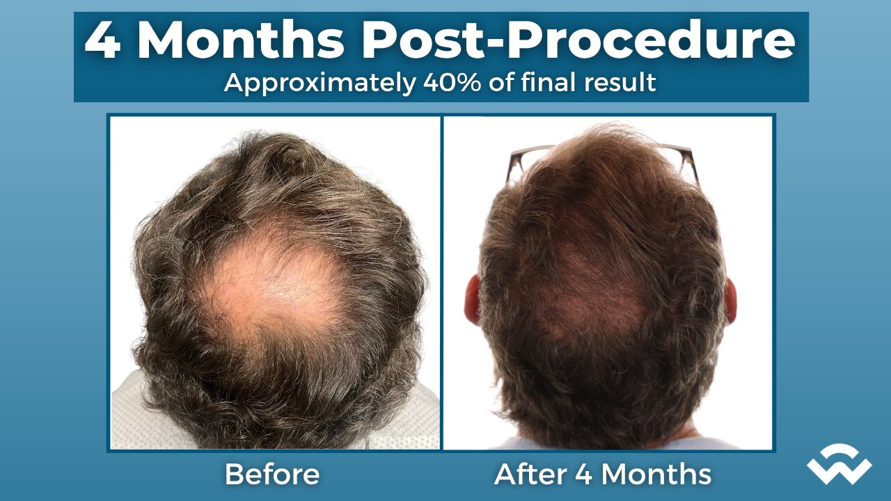 Only 40% of the Way There | Scott&rsquo;s 4-Month Hair Transplant Update