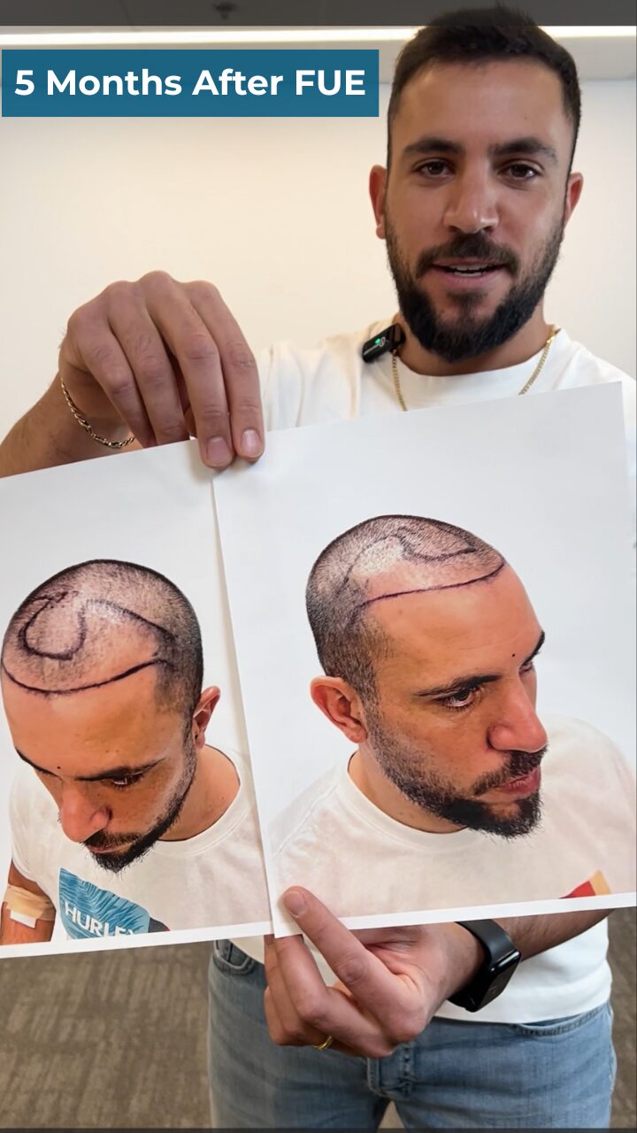 GAD FUE HAIR TRANSPLANT 5 months after