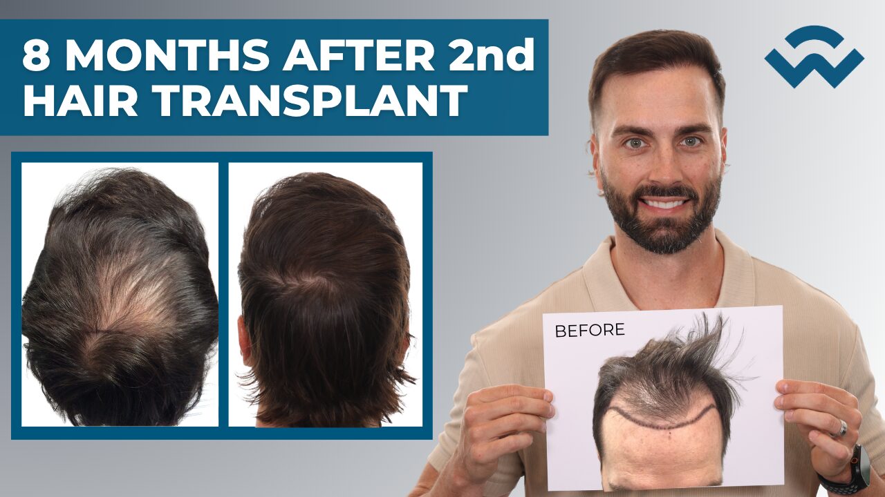 JOSH GARZA 8 months after 2nd hair transplant procedure