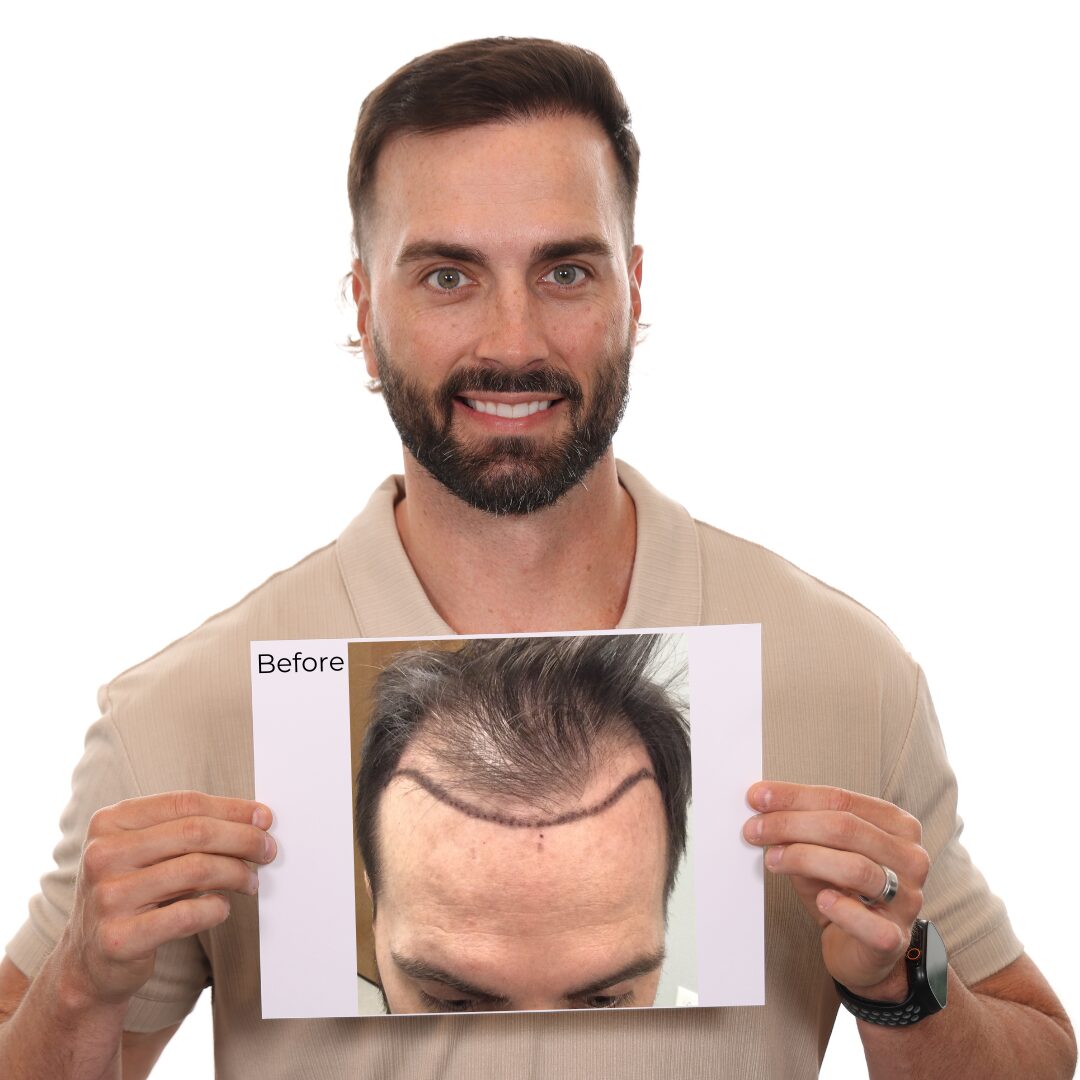 josh garza before and after hair transplant