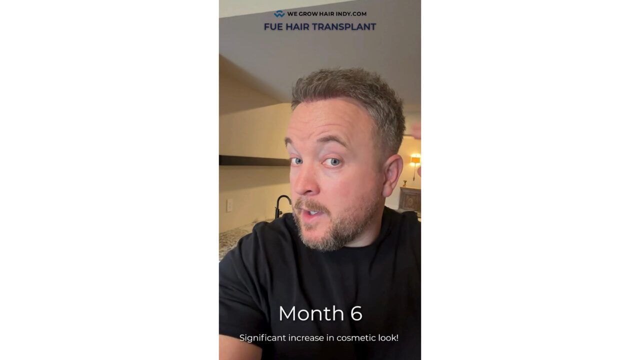 fue before and after at we grow hair indy