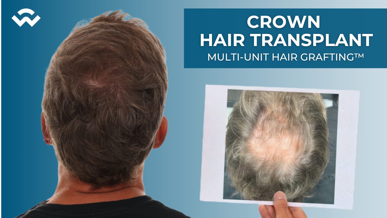 jon reens crown hair transplant