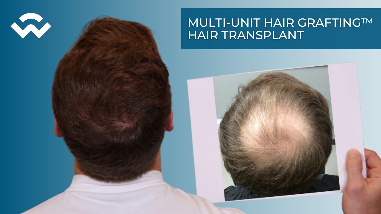 crown hair transplant result