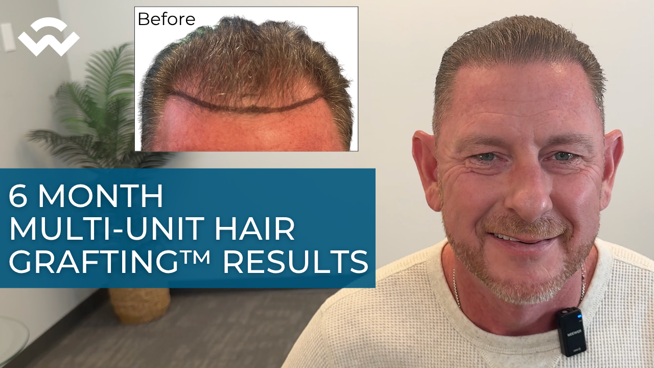 Todd Sowders 6mo after hair transplant