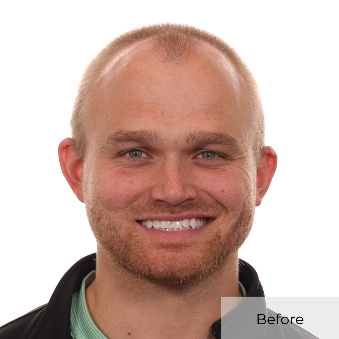 austin monday before hair transplant