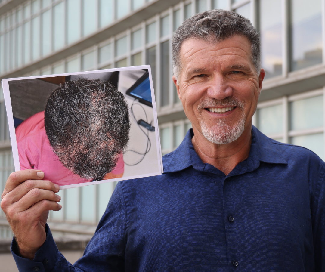 barry krauss we grow hair indy
