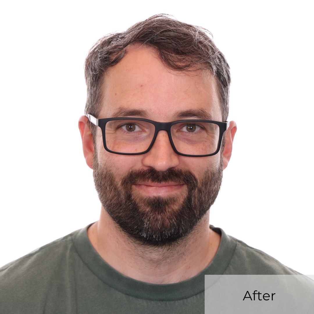 after hair transplant