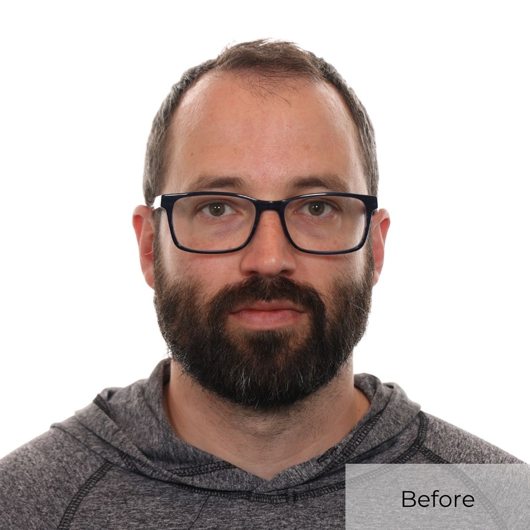 before hair transplant