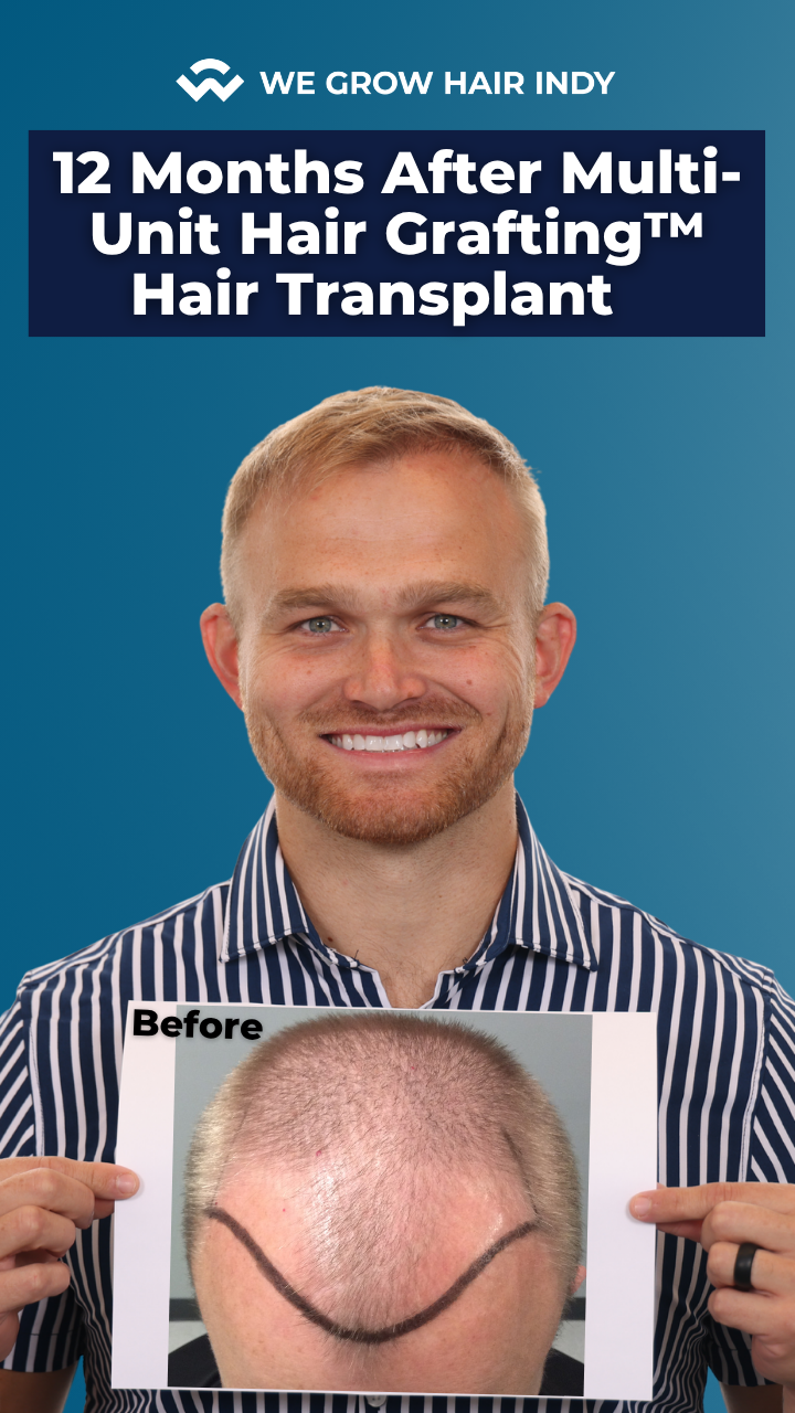 austin monday 12 months after hair transplant results