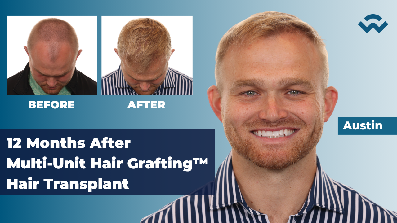 austin monday 12 months after hair transplant at we grow hair indy