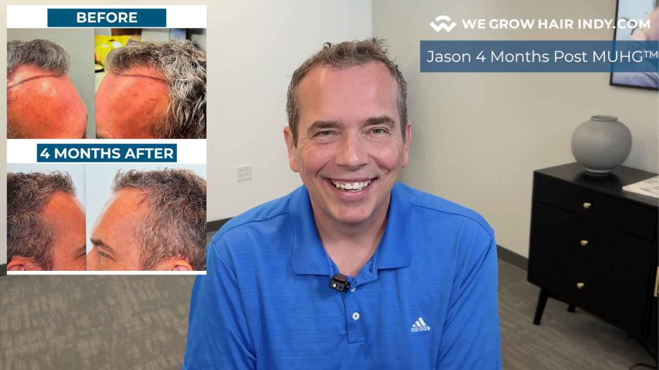 jason hammer 4 month hair transplant results