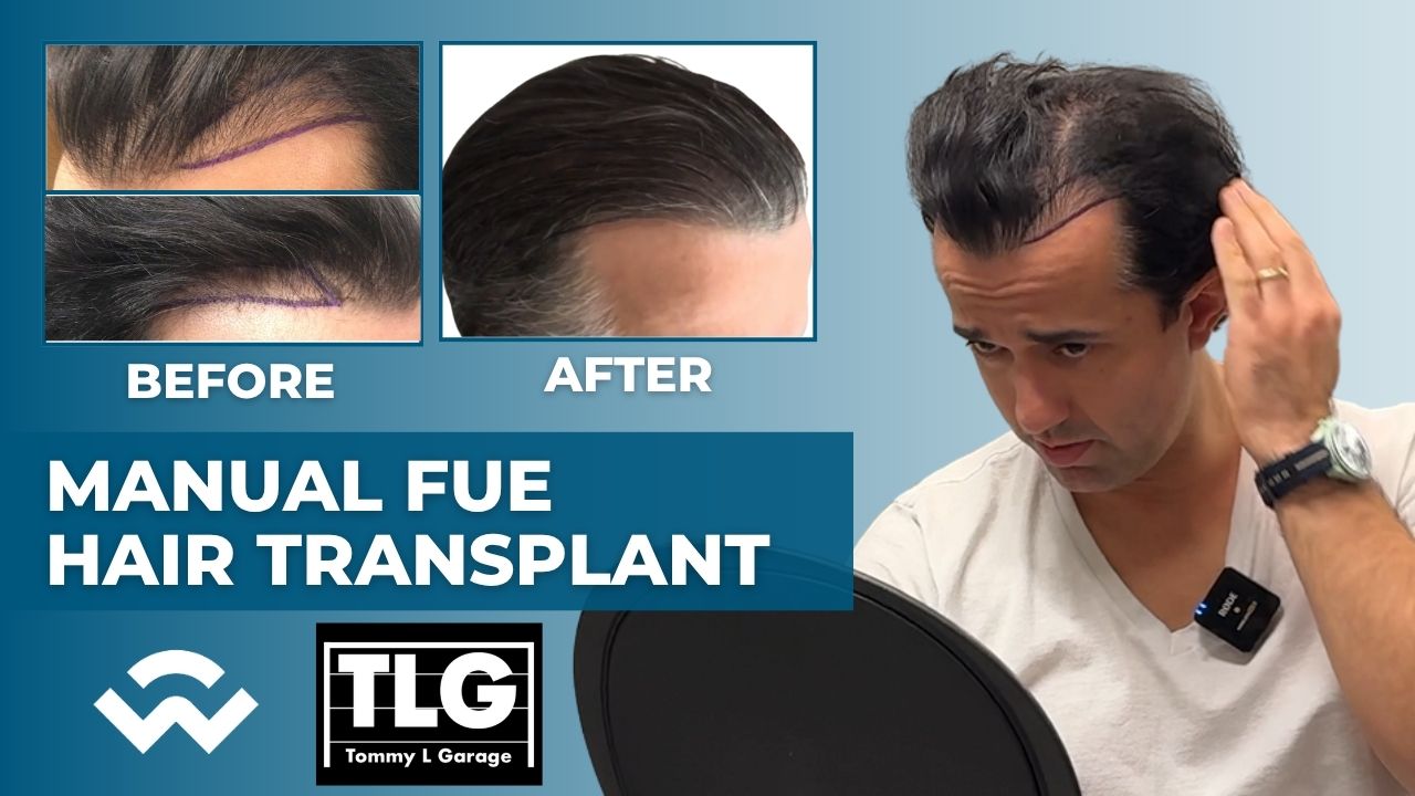 tommy garage manual fue hair transplant