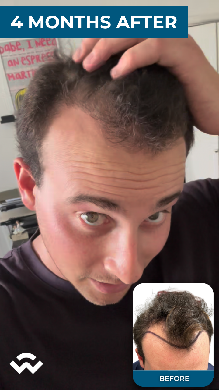 brandon reed 4 months after FUE